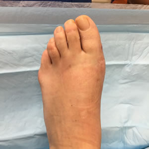 Bunion Surgery in the Midtown Manhattan, NY: Grand Central Park, Bryant Park, Rockefeller Center, Greenwich village, Chelsea, Gramercy Park, Peter Cooper Village, Hell's Kitchen, Lincoln Square, Manhattan Valley, Lenox Hill, Upper East Side,  Yorkville, Carnegie Hill, Hudson Square, Noho, Soho, Bowery areas