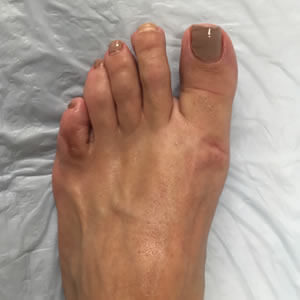 Bunion Care in the Midtown Manhattan, NY: Grand Central Park, Bryant Park, Rockefeller Center, Greenwich village, Chelsea, Gramercy Park, Peter Cooper Village, Hell's Kitchen, Lincoln Square, Manhattan Valley, Lenox Hill, Upper East Side,  Yorkville, Carnegie Hill, Hudson Square, Noho, Soho, Bowery areas