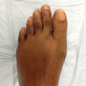 Bunions Removal Surgery in the Midtown Manhattan, NY: Greenwich village, Chelsea, Gramercy Park, Peter Cooper Village, Hell's Kitchen, Lincoln Square, Manhattan Valley, Lenox Hill, Upper East Side,  Yorkville, Carnegie Hill, Hudson Square, Noho, Soho, Bowery areas