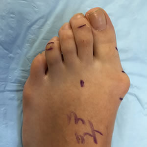 Bunion Removal in the Midtown Manhattan, NY: Greenwich village, Chelsea, Gramercy Park, Peter Cooper Village, Hell's Kitchen, Lincoln Square, Manhattan Valley, Lenox Hill, Upper East Side,  Yorkville, Carnegie Hill, Hudson Square, Noho, Soho, Bowery areas