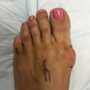 Bunion Surgery in the Midtown Manhattan, NY: Greenwich village, Chelsea, Gramercy Park, Peter Cooper Village, Hell's Kitchen, Lincoln Square, Manhattan Valley, Lenox Hill, Upper East Side,  Yorkville, Carnegie Hill, Hudson Square, Noho, Soho, Bowery areas