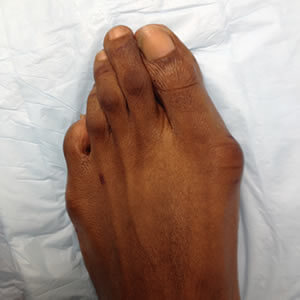 Bunion Treatment in the Midtown Manhattan, NY: Greenwich village, Chelsea, Gramercy Park, Peter Cooper Village, Hell's Kitchen, Lincoln Square, Manhattan Valley, Lenox Hill, Upper East Side,  Yorkville, Carnegie Hill, Hudson Square, Noho, Soho, Bowery areas