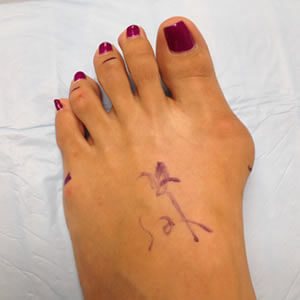 Bunion Treatment & Recovery in the Midtown Manhattan, NY: Greenwich village, Chelsea, Gramercy Park, Peter Cooper Village, Hell's Kitchen, Lincoln Square, Manhattan Valley, Lenox Hill, Upper East Side,  Yorkville, Carnegie Hill, Hudson Square, Noho, Soho, Bowery areas