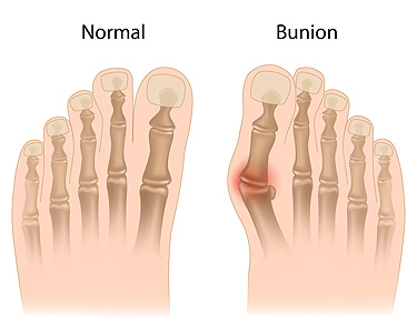 Bunions treatment in the Midtown Manhattan, NY: Greenwich village, Chelsea, Gramercy Park, Peter Cooper Village, Hell's Kitchen, Lincoln Square, Manhattan Valley, Lenox Hill, Upper East Side,  Yorkville, Carnegie Hill, Hudson Square, Noho, Soho, Bowery areas