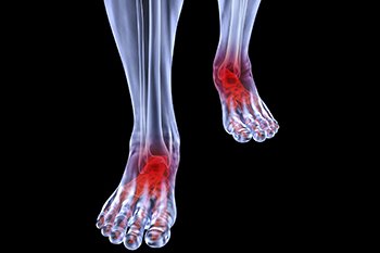 Arthritic foot and ankle care treatment in the Midtown Manhattan, NY: Greenwich village, Chelsea, Gramercy Park, Peter Cooper Village, Hell's Kitchen, Lincoln Square, Manhattan Valley, Lenox Hill, Upper East Side,  Yorkville, Carnegie Hill, Hudson Square, Noho, Soho, Bowery areas