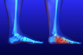 Flat Feet Treatment in the Midtown Manhattan, NY: Greenwich village, Chelsea, Gramercy Park, Peter Cooper Village, Hell's Kitchen, Lincoln Square, Manhattan Valley, Lenox Hill, Upper East Side,  Yorkville, Carnegie Hill, Hudson Square, Noho, Soho, Bowery areas