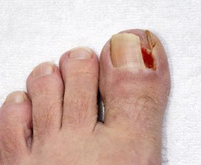 Ingrown toenail in the Midtown Manhattan, NY: Grand Central Park, Bryant Park, Rockefeller Center, Greenwich village, Chelsea, Gramercy Park, Peter Cooper Village, Hell's Kitchen, Lincoln Square, Manhattan Valley, Lenox Hill, Upper East Side,  Yorkville, Carnegie Hill, Hudson Square, Noho, Soho, Bowery areas