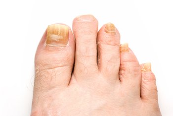 Toenail fungus treatment in the Midtown Manhattan, NY: Greenwich village, Chelsea, Gramercy Park, Peter Cooper Village, Hell's Kitchen, Lincoln Square, Manhattan Valley, Lenox Hill, Upper East Side,  Yorkville, Carnegie Hill, Hudson Square, Noho, Soho, Bowery areas