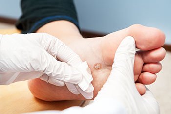 Plantar Warts Treatment in the Midtown Manhattan, NY: Grand Central Park, Bryant Park, Rockefeller Center, Greenwich village, Chelsea, Gramercy Park, Peter Cooper Village, Hell's Kitchen, Lincoln Square, Manhattan Valley, Lenox Hill, Upper East Side,  Yorkville, Carnegie Hill, Hudson Square, Noho, Soho, Bowery areas
