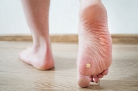 Some Children May Be Prone to Plantar Warts