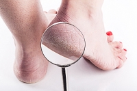 Are Cracked Heels a Common Ailment?