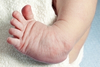 Causes and Definition of Clubfoot